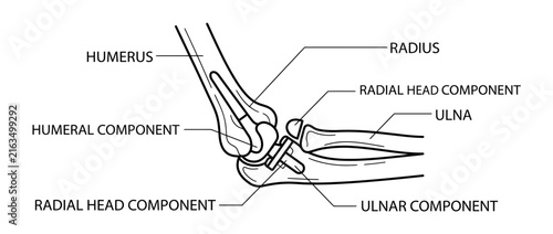 Diagram of Elbow Joint with Prosthetic Components