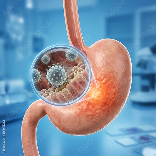 3d medical illustration of a human stomach showing viral infection and inflammation of the gastric lining with microscopic view of viral particles