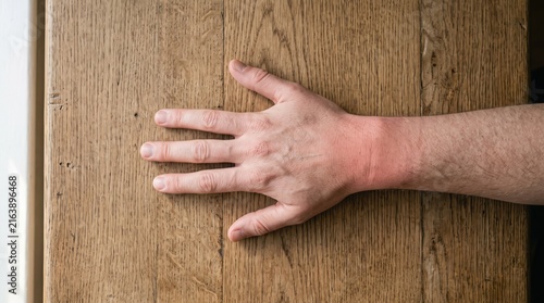 Close up of a male hand with a red swollen wrist resting on a wooden table, showing signs of inflammation, arthritis, gout, or injury pain, requiring medical treatment