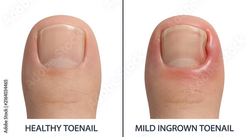 Healthy and ingrown toenail comparison on foot
