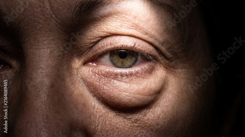 Close-up of Mature Woman Eye with Prominent Under Eye Bag and Swelling