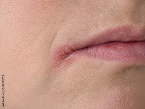 Close up of cracked, red inflammation at the corner of the mouth, indicating angular cheilitis or a cold sore.