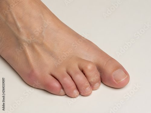 Close up of a human foot with hammertoe deformity, showing bent and curled toes.