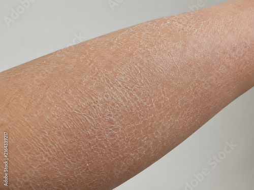 Close up of severely dry, scaly, and flaky human skin texture, indicating xerosis or ichthyosis.