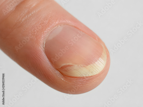 Close up of a damaged fingernail showing signs of fungal infection, psoriasis, or vitamin deficiency.