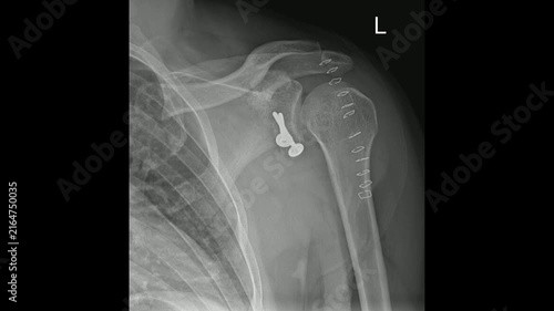 Postoperative X-ray of Left Shoulder Showing Surgical Fixation Hardware in Shoulder joint