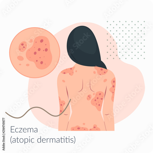 Skin Rashes Eczema atopic dermatitis on back- Stock Illustration