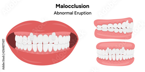 Hand-drawn medical and dental health illustration depicting abnormal tooth eruption, a condition in which a tooth does not emerge through the gum in its expected position, direction, or timing