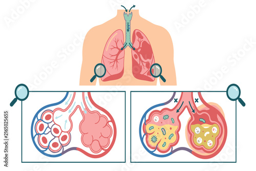 Professional healthcare infographic explaining pneumonia effects on alveolar health, emphasizing inflamed air sacs, fluid accumulation, impaired respiration, and oxygen exchange.