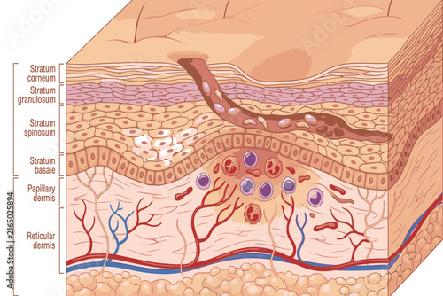 Medical illustration showing a Sarcoptes scabiei mite burrowing through the epidermis, illustrating skin infestation, tunnel formation, and parasite activity.