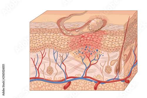 Professional medical infographic illustrating the Sarcoptes scabiei mite burrowing beneath the epidermis, with visible tunnels, parasite activity, and skin reaction.