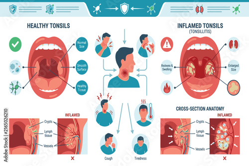 Medical infographic comparing healthy tonsils and tonsillitis, highlighting inflammation, swelling, redness, infection, symptoms, and anatomical differences.