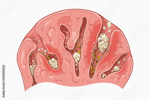 Professional medical infographic highlighting tonsil stones embedded in tonsil crypts, with detailed anatomy of trapped particles, bacterial biofilm, and mineralized deposits.
