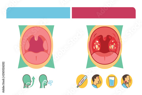 Educational medical infographic comparing normal and inflamed tonsils, illustrating swelling, redness, infection signs, white patches, and common symptoms.