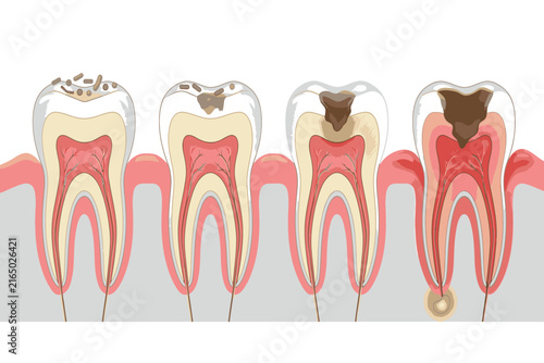 Medical infographic illustrating tooth decay progression from enamel damage to dentin and pulp involvement, showing cavities and progressive dental tissue destruction.