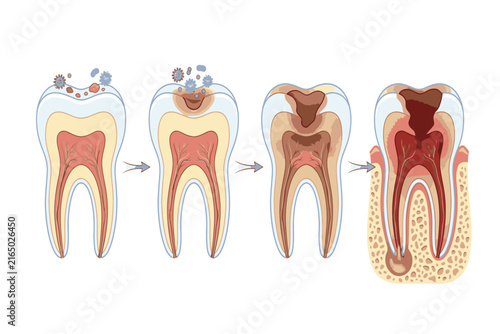 Educational dental infographic comparing healthy and progressively decayed teeth, highlighting enamel breakdown, dentin involvement, pulp exposure, and bacterial infection.