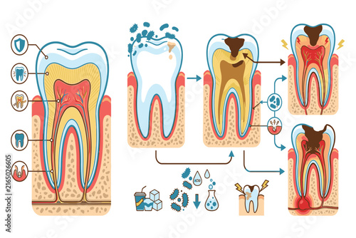 Professional medical infographic demonstrating tooth decay progression through different anatomical layers, from enamel deterioration to deep pulp involvement and infection.