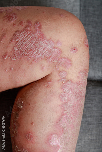Close-up of inflamed dry scaly skin on a human leg, A chronic skin condition with redness, irritation, and flaky texture for healthcare and dermatology