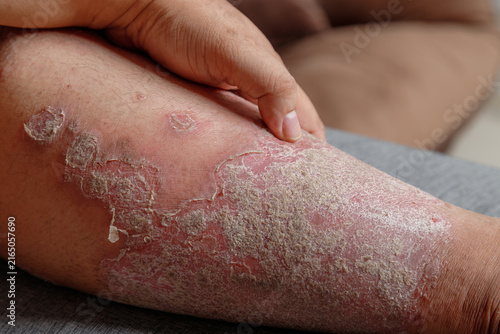 Close-up of inflamed dry scaly skin on a human leg, A chronic skin condition with redness, irritation, and flaky texture for healthcare and dermatology