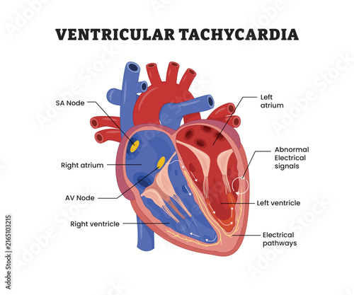 Canvastavla Ventricular Tachycardia labeled diagram, educational medical poster design healthcare scheme, cardiac arrhythmia, abnormal electrical signals
