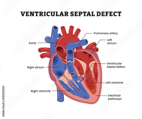 Obraz na płótnie Ventricular Septal Defect labeled diagram, educational medical poster design healthcare scheme, congenital heart disease, cardiac shunt