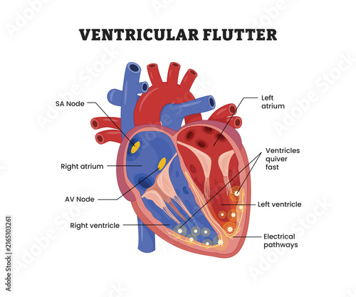 Canvas Print Ventricular Flutter labeled diagram, educational medical poster design healthcare scheme, cardiac arrhythmia, rapid ventricular rhythm