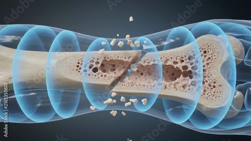 Medical animation of a bone fracture showing internal structure and bone fragments