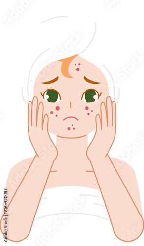 woman worried with acne problem