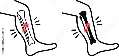 Bone fracture and leg injury icons set for medical and healthcare design. Collection of lower leg bone fracture symbols highlighting broken tibia and fibula. Vector illustration