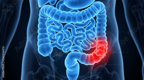 3D human anatomy illustration of inflamed colon and intestinal tract