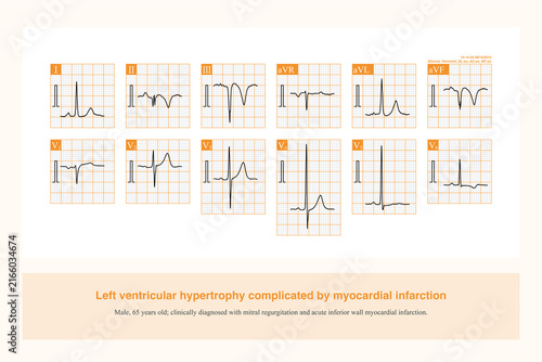 Photography In patients with left ventricular hypertrophy, the occurrence of ST-segment elev