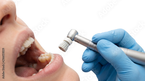 Professional dental polishing procedure, dentist cleaning teeth with rotary brush tool, oral hygiene and plaque removal treatment isolated PNG with Transparent Background