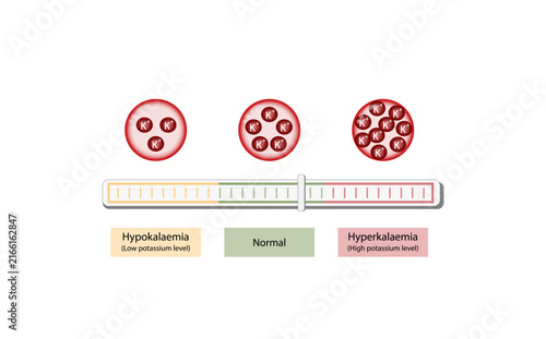 Bild auf Leinwand Hyperkalaemia, high plasma potassium level and Hypokalaemia, low plasma potassium level
