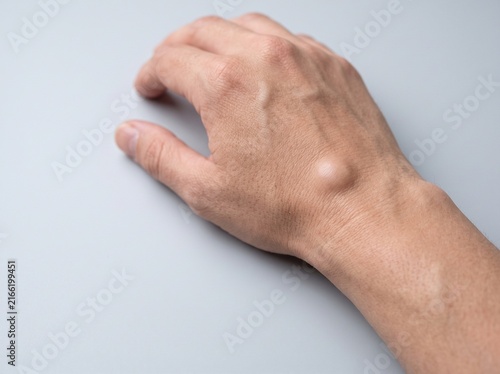 Small Early Ganglion Cyst on the Wrist