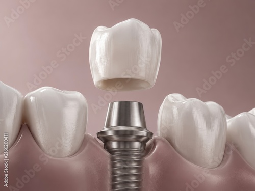 Ceramic Crown Aligned Above Implant Post