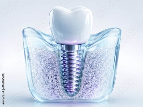 Implant Screw Inside Blue Transparent Jaw
