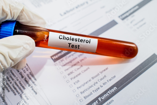 Foto blood sample in lab test tube for Cholesterol test
