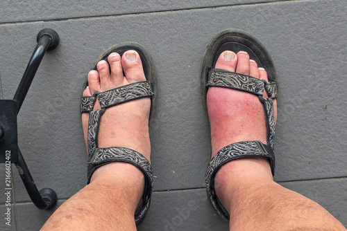 Konstfotografi Man with swollen inflamed painful right foot due to acute gout attack