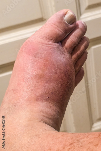 Obraz na plátně Close-up of real swollen inflamed painful right foot due to acute gout attack