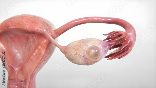 Ovarian cyst in human ovary, photorealistic medical 3D render showing preserved female reproductive anatomy and clear cystic lesion for healthcare, medical education, radiology, and patient education
