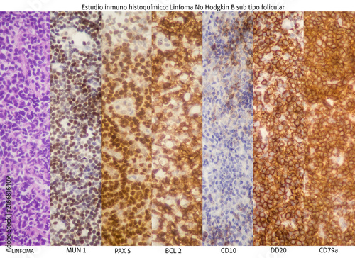 Microscopic image showing a follicular subtype of B-cell non-Hodgkin lymphoma.