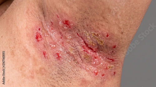 Severe inflamed axillary intertrigo and skin infection in human armpit