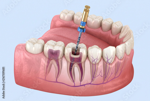 Detailed 3D Dental Root Canal Illustration for Patient Education