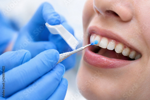Fluoride Treatment After Routine Dental Cleaning