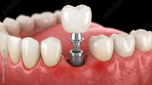 Modern Dental Implant Placement for Tooth Restoration.