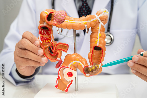 Obraz na płótnie Colorectal cancer, doctor holding intestine colon human model.