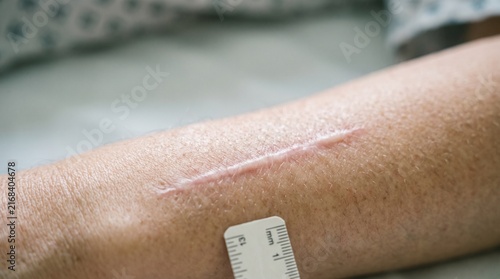 Close up of arm with medical identification band.