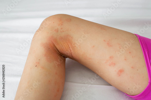 Принти на полотні Close-up of child's leg with red itchy eczema rash, irritated dry skin, illustra