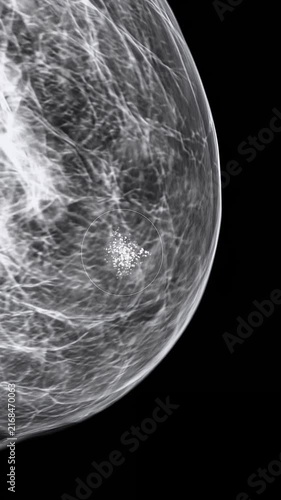 Mammogram shows suspicious breast lesion. Cancer screening and early detection for healthcare with copy space