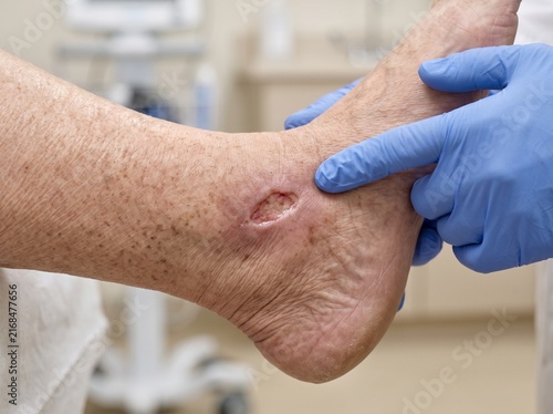 Close Up Assessment of Venous Leg Ulcer in Elderly Patient